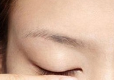 单眼皮变双眼皮方法,单眼皮怎么变双眼皮图5
