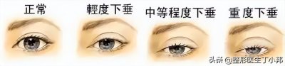 ​下眼皮松弛怎么办 眼周年轻化·眼皮下垂了该如何有效抗衰？