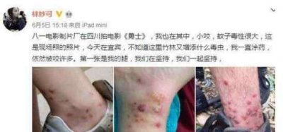 ​林妙可被毒虫咬伤 林妙可被毒虫咬伤照片，触目惊心脚腕全是伤痕