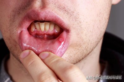 ​口腔癌早期有什么征兆 口腔癌早期有什么征兆？记住4个症状，别错过抓癌时机