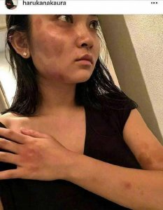 ​蒋劲夫女友曝出家暴经过，称被打掉两颗牙齿，背后真相究竟如何？