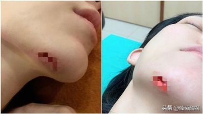 ​范玮琪深夜惨摔！下巴破大洞血肉全露缝15针，伤口骇人